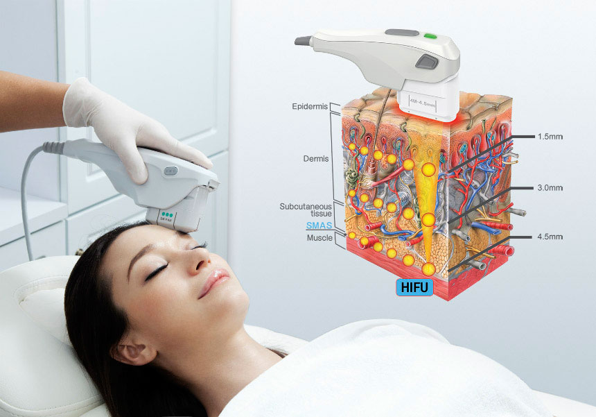 HIFU Face Lift - non-Invasive Treatment